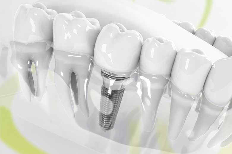 implants-dentise-dahm-02